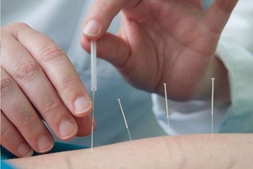 Acupuncture - a method for treating pain in the lumbar region caused by osteochondrosis