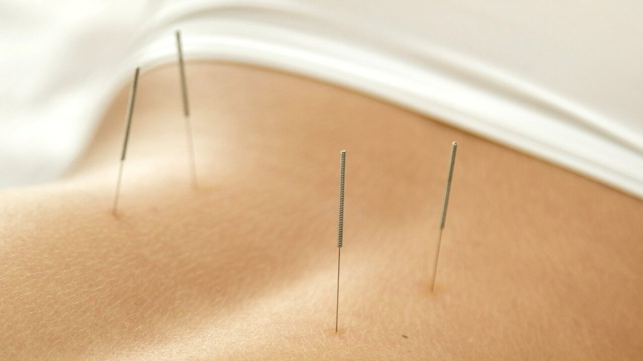 Acupuncture will help to get rid of back pain